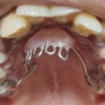 The Thumb Sucking Habit Breaker