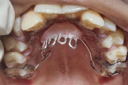 The Thumb Sucking Habit Breaker