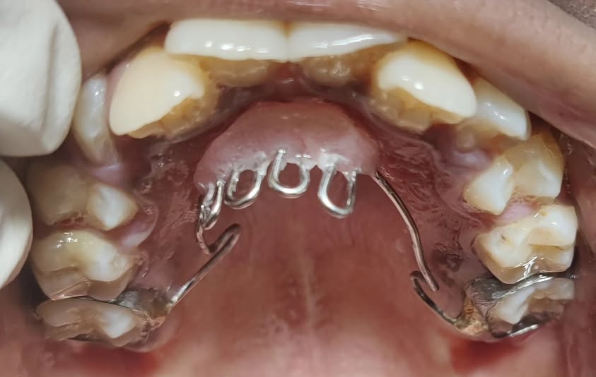The Thumb Sucking Habit Breaker