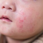 婴儿 湿疹：了解、预防与护理指南