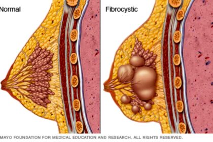 The Fibrocystic Breast Disease Specialist: Understanding, Diagnosing, and Managing a Common Breast Condition