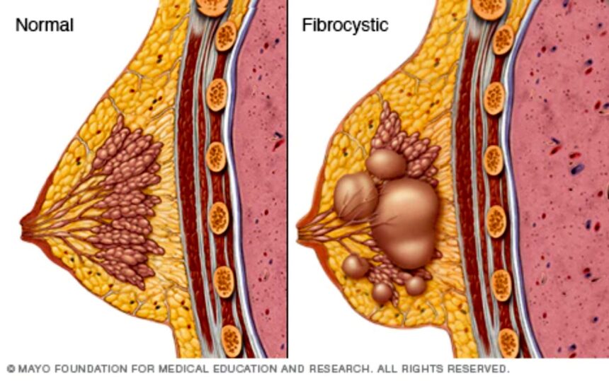 The Fibrocystic Breast Disease Specialist: Understanding, Diagnosing, and Managing a Common Breast Condition