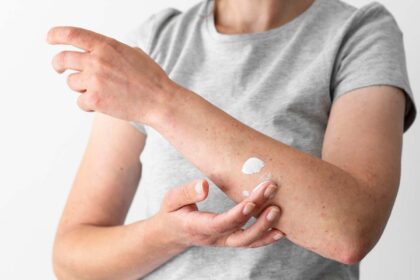 Hongos En La Piel Manchas: A Complete Guide to Recognizing, Treating, and Preventing