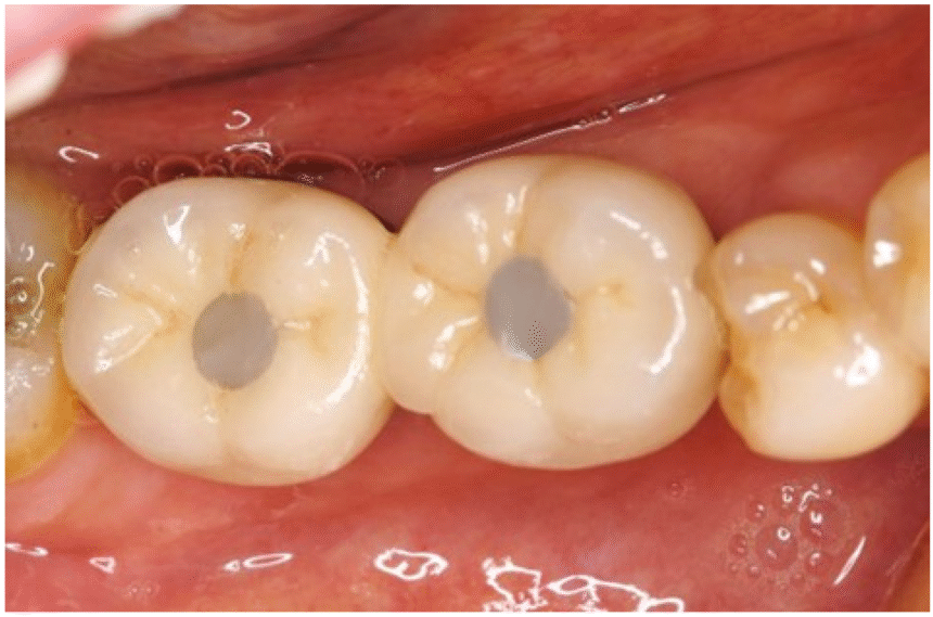 The Teeth Hole Repair: A Comprehensive Guide to Restoring Your Smile
