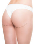 Los Implantes de Nalgas: Una Guía Completa sobre la Cirugía y sus Implicaciones