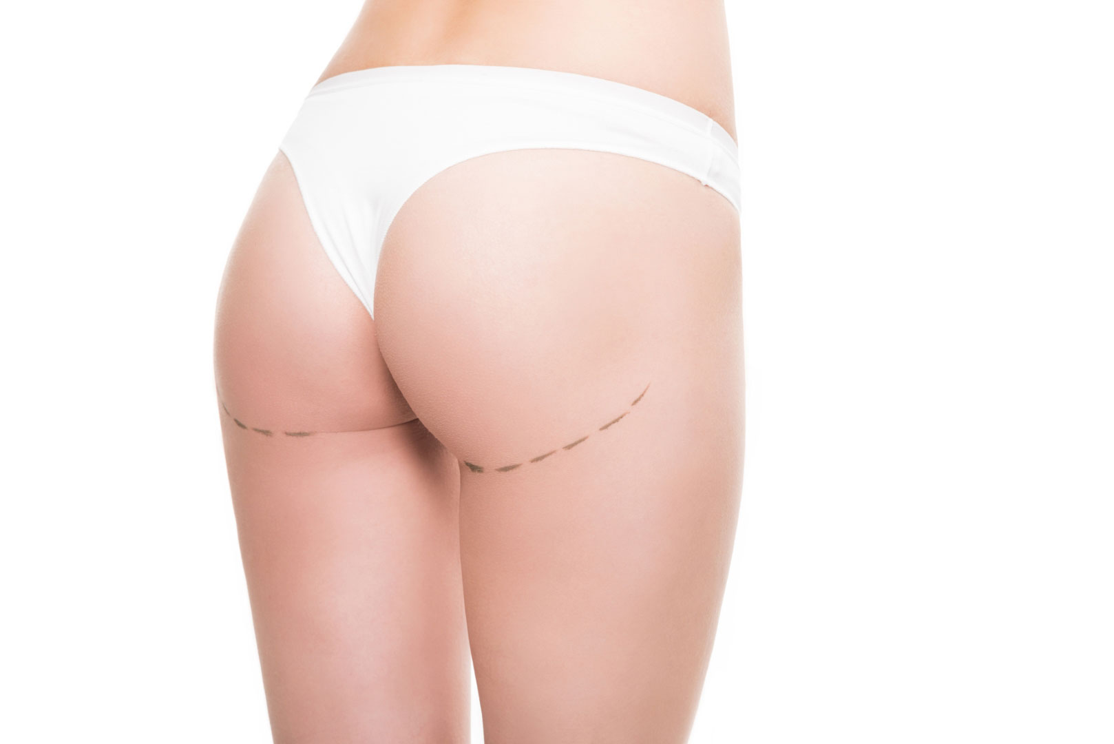 Los Implantes de Nalgas: Una Guía Completa sobre la Cirugía y sus Implicaciones