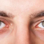 Konjuktivitis: Alles, was Sie wissen müssen