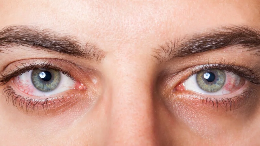 Konjuktivitis: Alles, was Sie wissen müssen