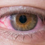 Nube en el ojo: Comprendiendo la condición de la visión borrosa y sus posibles causas