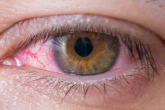 Nube en el ojo: Comprendiendo la condición de la visión borrosa y sus posibles causas